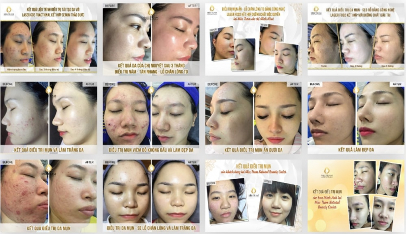 Miss Trâm – Natural Beauty Center: Chuyên trị sẹo rỗ, sẹo mụn có cam kết ở HCM